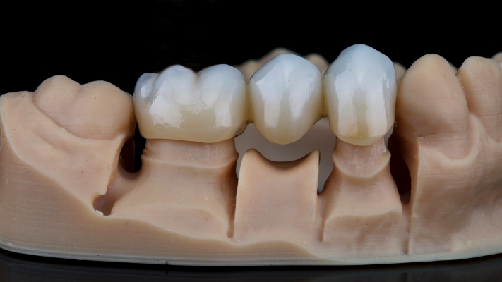 Próteses Dentárias